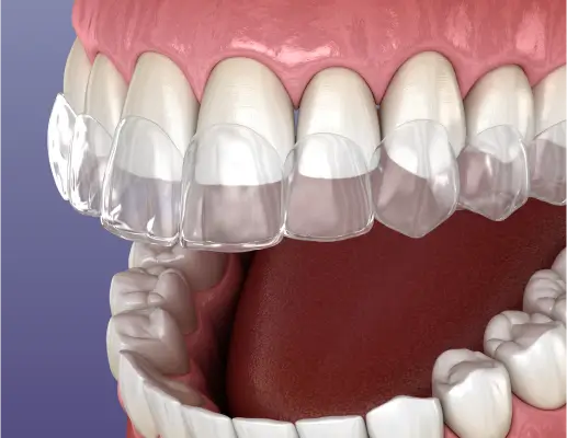 Invisalign clear aligners at Race Track Smiles in Tampa, FL