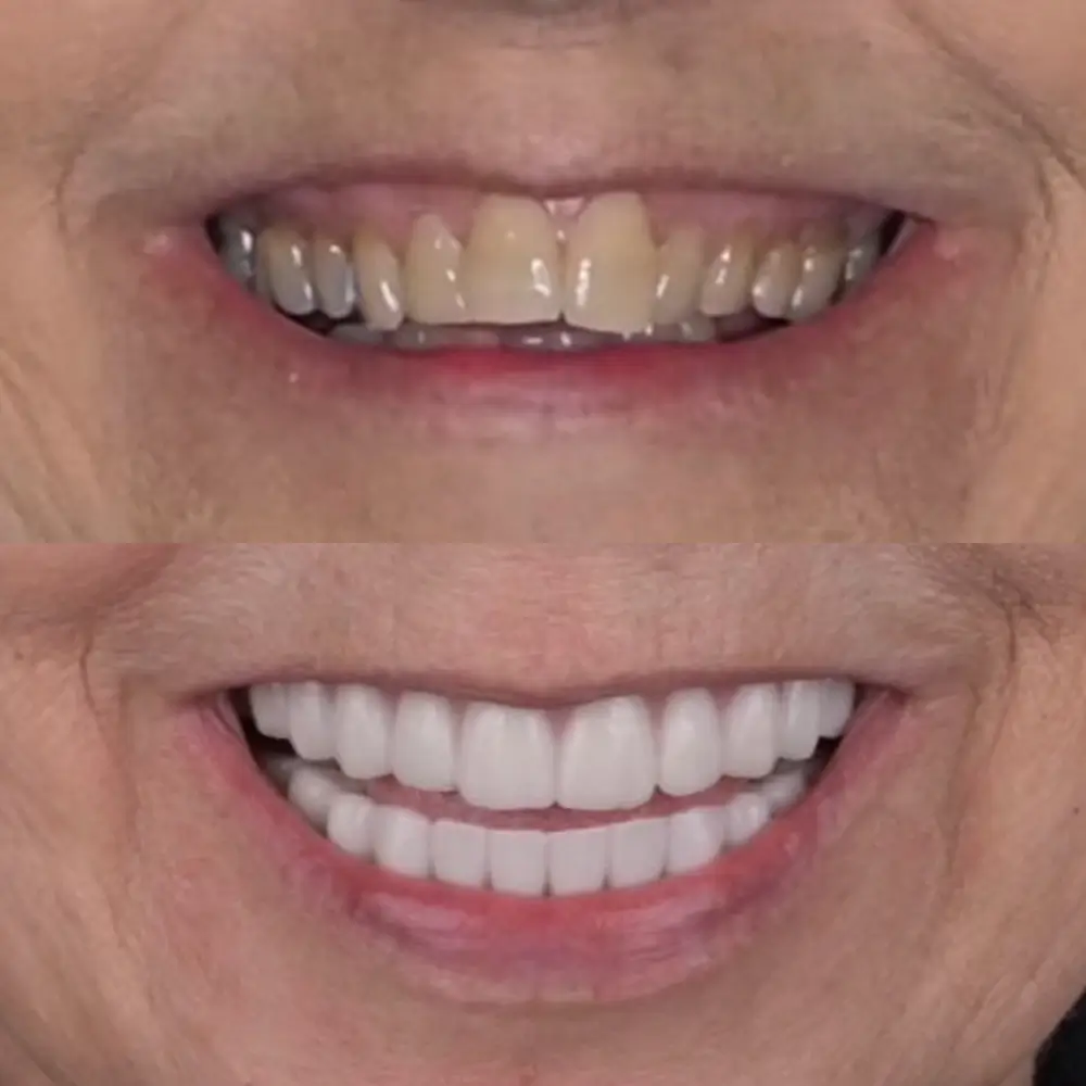 Before and After Smile Transformation 1