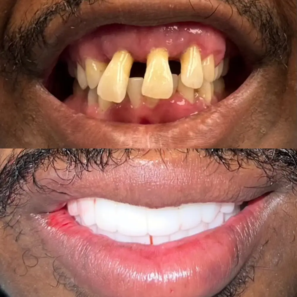 Before and After Smile Transformation 2