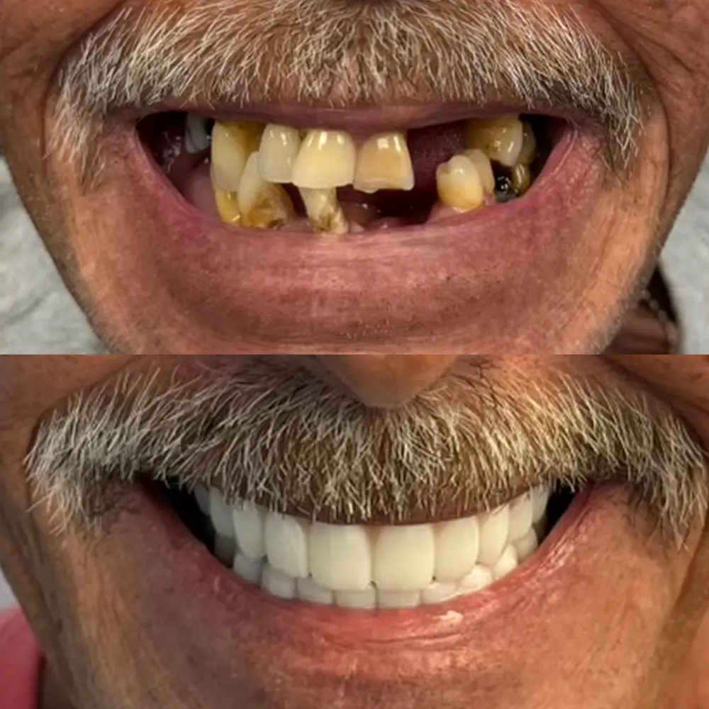 Before and After Smile Transformation 3
