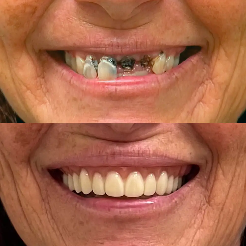 Before and After Smile Transformation 4