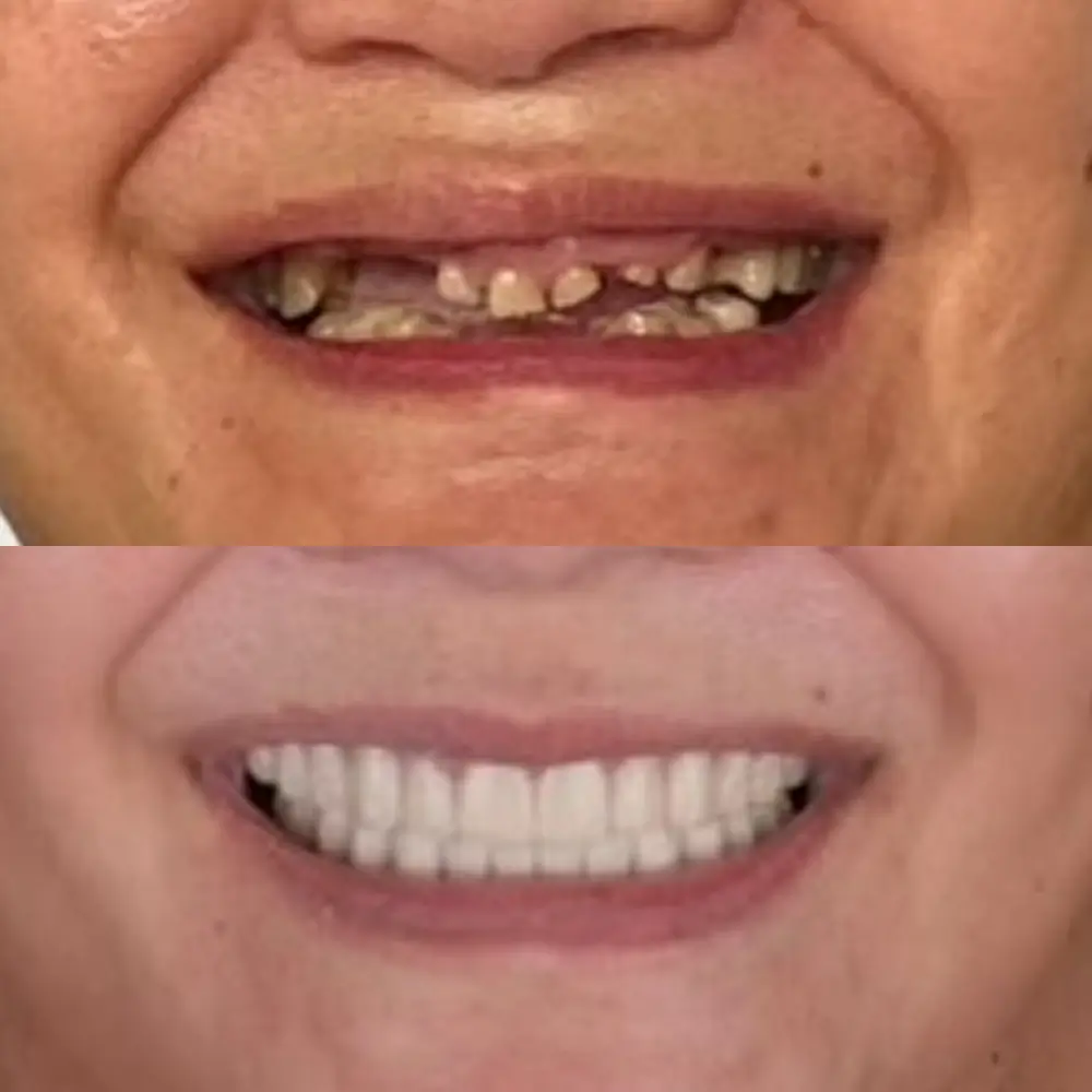 Before and After Smile Transformation 5
