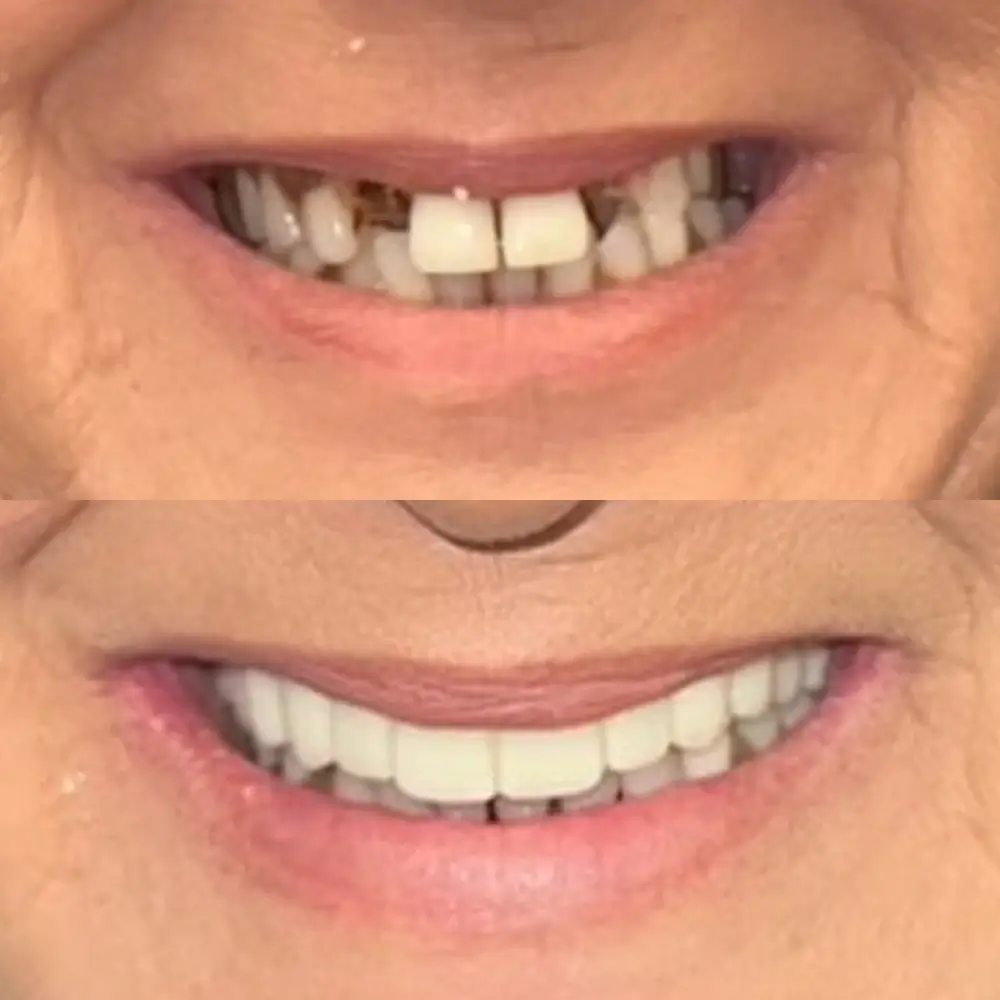 Before and After Smile Transformation 6