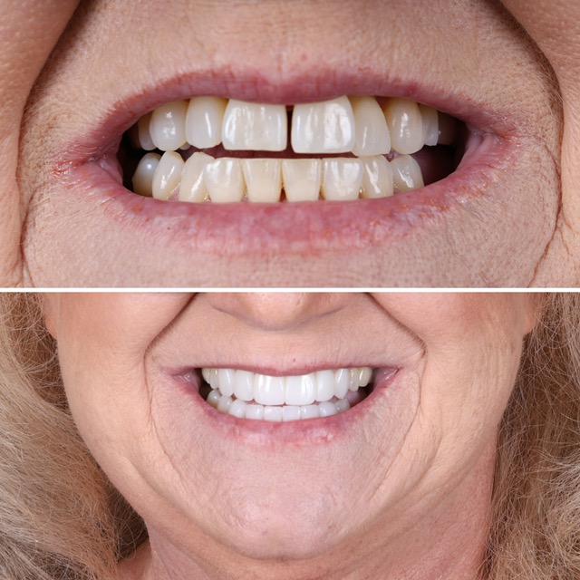 Before and After Smile Transformation 8