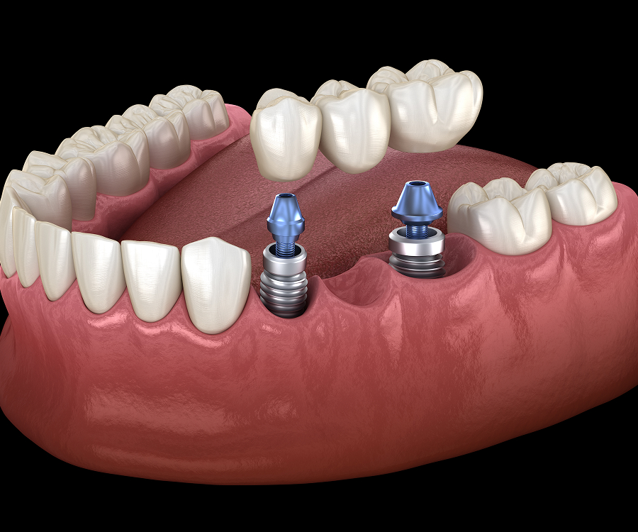 Dental Crowns and Bridges in Tampa, FL