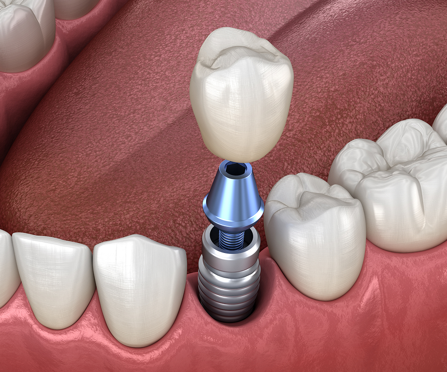 Dental Implants in Tampa, FL