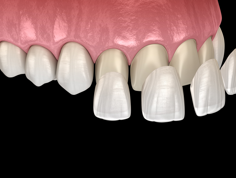 Dental Veneers at Race Track Smiles in Tampa, FL