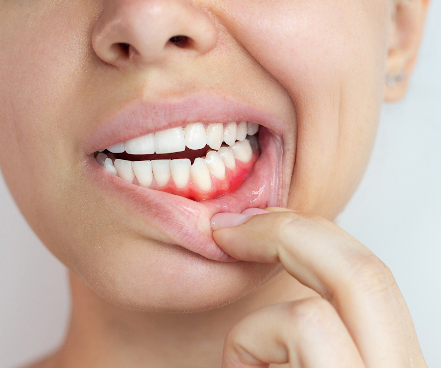 Gum Disease Treatment in Tampa, FL