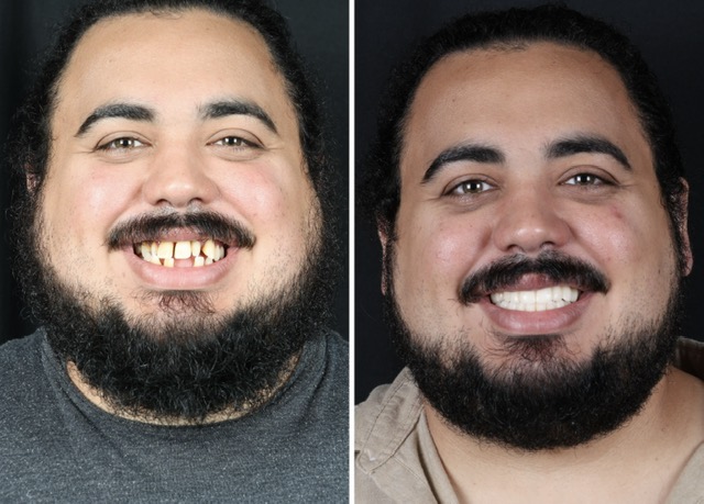 Race Track Dental patient before and after smile transformation 1
