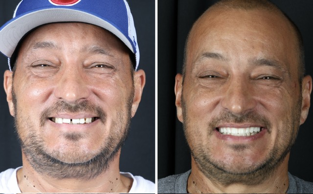 Race Track Dental patient before and after smile transformation 2