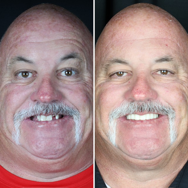 Race Track Dental patient before and after smile transformation 3
