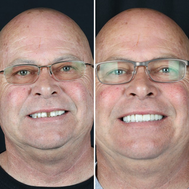 Race Track Dental patient before and after smile transformation 4