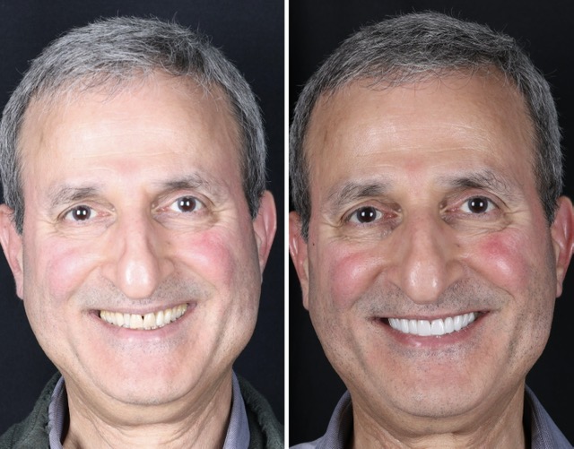 Race Track Dental patient before and after smile transformation 5