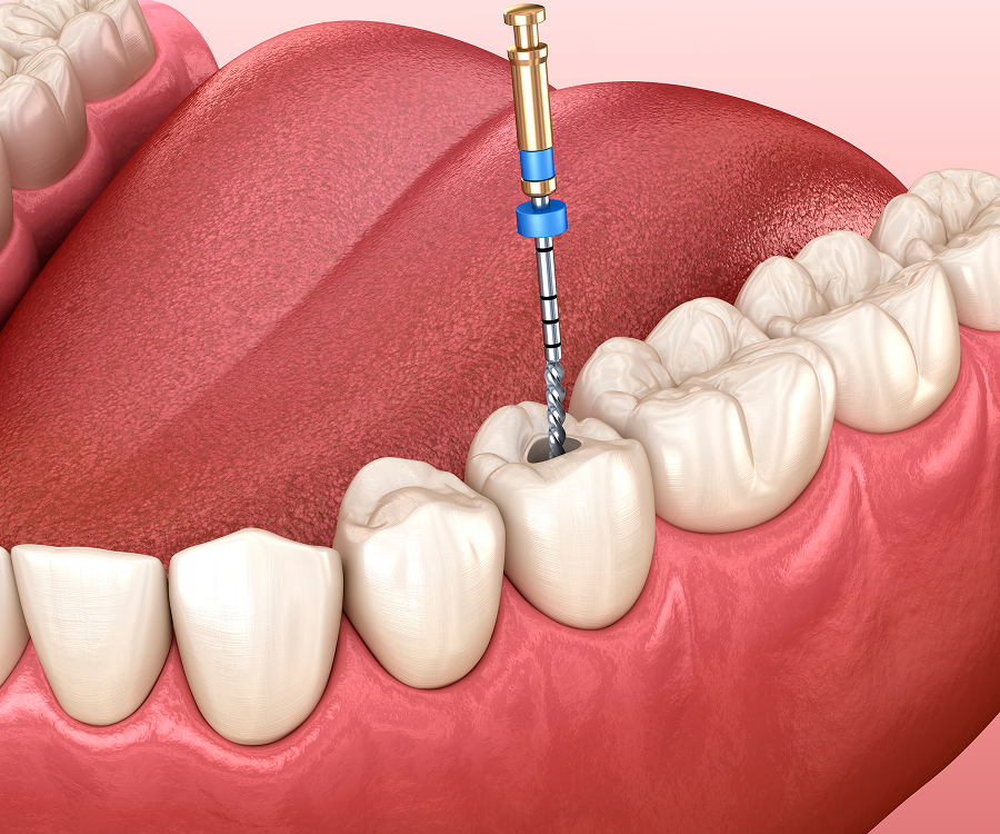 Root Canal Treatment in Tampa, FL