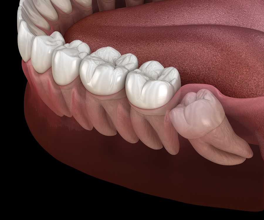 Wisdom Teeth Removal in Tampa, FL