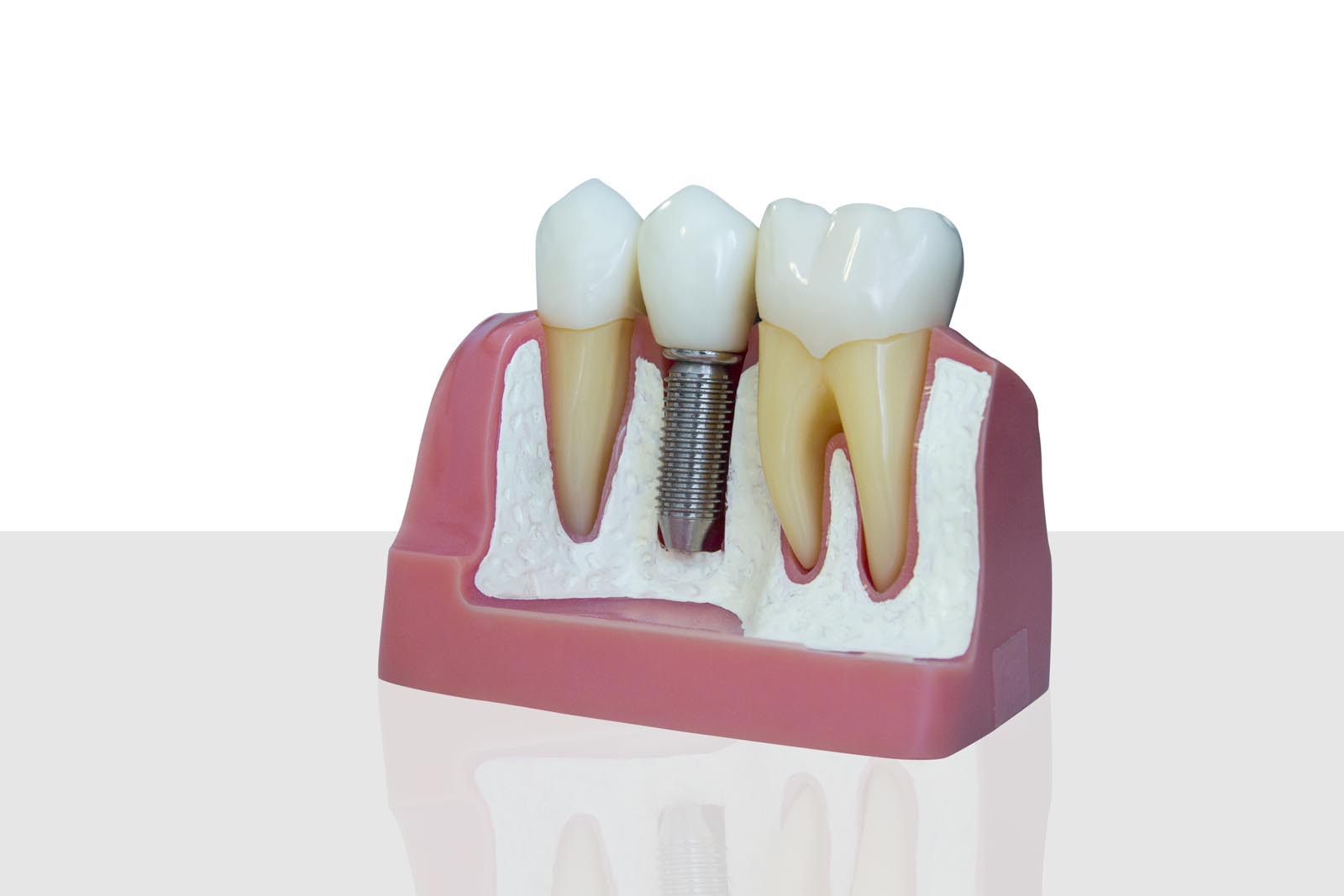 Frequently Asked Questions About Dental Implants
