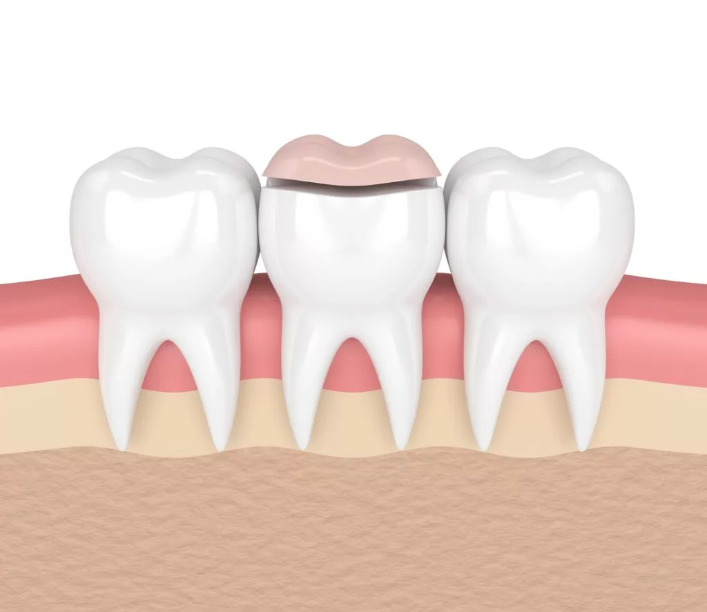 Dental Inlays & Onlays