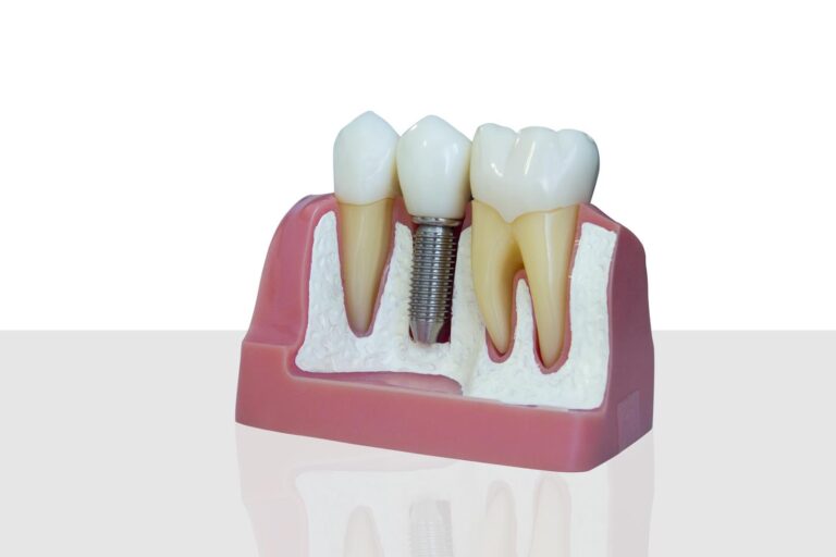 Model of a dental implant.